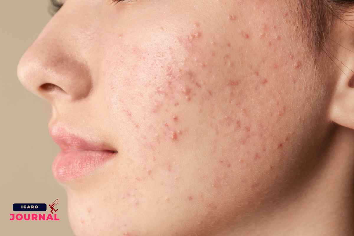 Aloe vera contro i brufoli - IcaroJournal