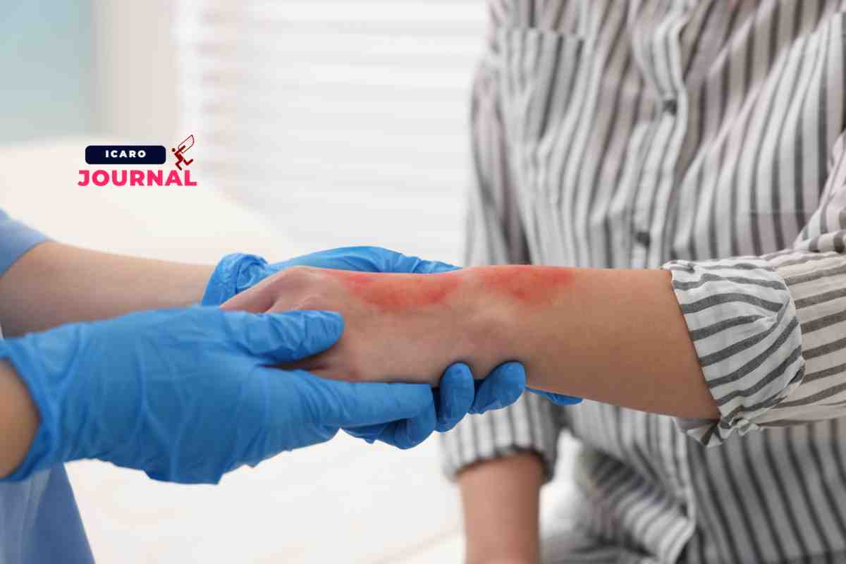 Bruciature rimedio naturale - IcaroJournal