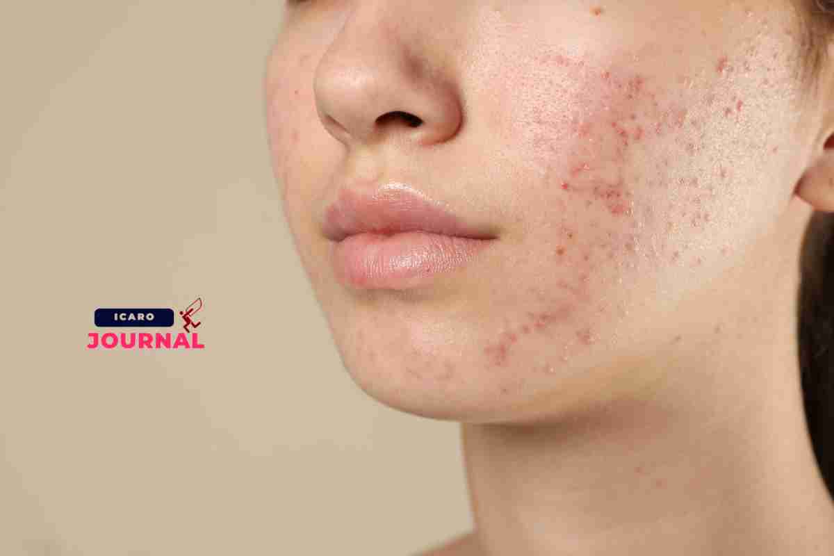 Brufoli come agire - IcaroJournal