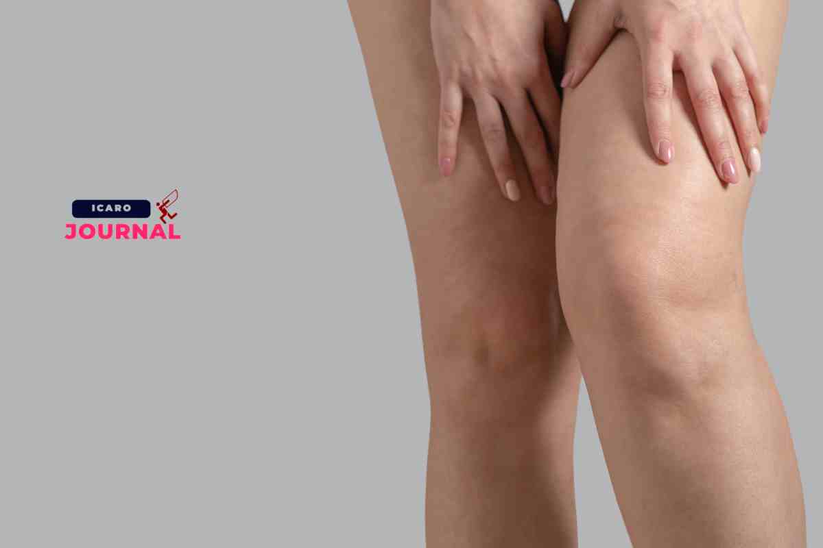 Cellulite problema al femminile come risolverlo - IcaroJournal