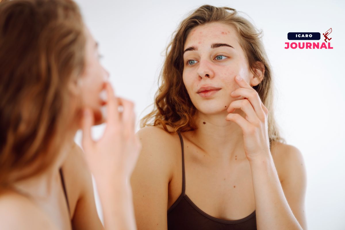 Ovaio policistico capelli acne ciclo irregolare - IcaroJournal